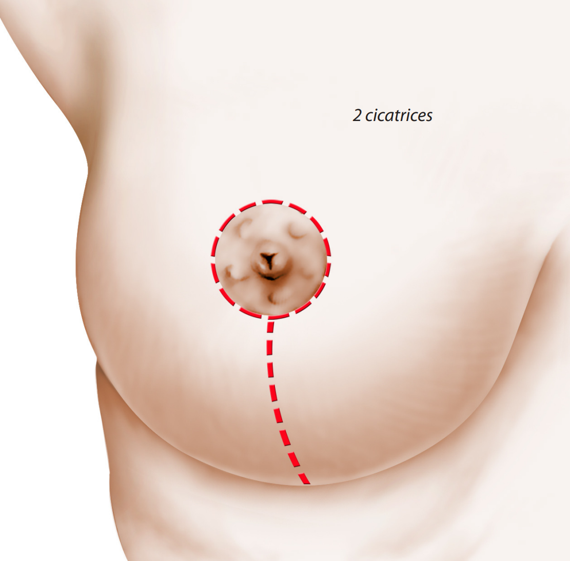 schéma incision opération réduction mammaire a deux cicatrices – Docteur Yoni Madar