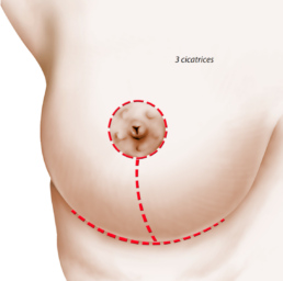 schéma incision opération réduction mammaire a trois cicatrices – Docteur Yoni Madar